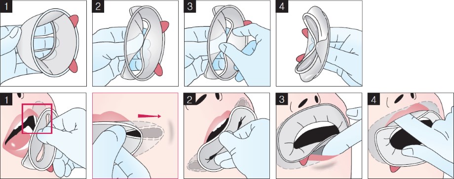 Схема использования средства для расширения рабочего поля OptraGate