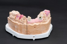 Изготовление индивидуальных абатментов из оксида циркония (IPS e.max ZirCAD) с титановым (Ti) основанием