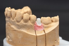 Изготовление индивидуальных абатментов из оксида циркония (IPS e.max ZirCAD) с титановым (Ti) основанием