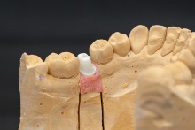 Изготовление индивидуальных абатментов из оксида циркония (IPS e.max ZirCAD) с титановым (Ti) основанием