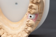 Изготовление индивидуальных абатментов из оксида циркония (IPS e.max ZirCAD) с титановым (Ti) основанием