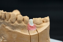 Изготовление индивидуальных абатментов из оксида циркония (IPS e.max ZirCAD) с титановым (Ti) основанием