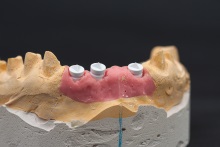 Изготовление индивидуальных абатментов из оксида циркония (IPS e.max ZirCAD) с титановым (Ti) основанием