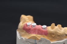 Изготовление индивидуальных абатментов из оксида циркония (IPS e.max ZirCAD) с титановым (Ti) основанием