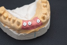 Изготовление индивидуальных абатментов из оксида циркония (IPS e.max ZirCAD) с титановым (Ti) основанием