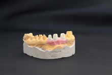 Изготовление индивидуальных абатментов из оксида циркония (IPS e.max ZirCAD) с титановым (Ti) основанием