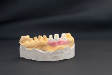 Изготовление индивидуальных абатментов из оксида циркония (IPS e.max ZirCAD) с титановым (Ti) основанием