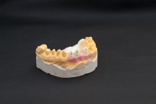 Изготовление индивидуальных абатментов из оксида циркония (IPS e.max ZirCAD) с титановым (Ti) основанием