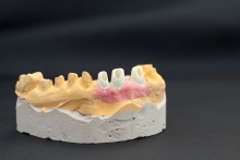 Изготовление индивидуальных абатментов из оксида циркония (IPS e.max ZirCAD) с титановым (Ti) основанием