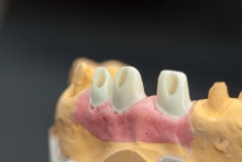 Изготовление индивидуальных абатментов из оксида циркония (IPS e.max ZirCAD) с титановым (Ti) основанием