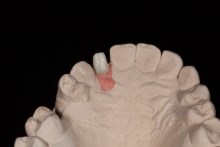 Изготовление индивидуальных абатментов из оксида циркония (IPS e.max ZirCAD) с титановым (Ti) основанием