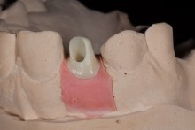 Изготовление индивидуальных абатментов из оксида циркония (IPS e.max ZirCAD) с титановым (Ti) основанием