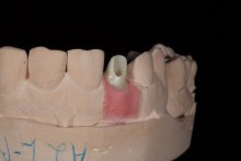Изготовление индивидуальных абатментов из оксида циркония (IPS e.max ZirCAD) с титановым (Ti) основанием