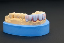 Изготовление полноанатомического мостовидного протеза из литий дисиликата (IPS e.max CAD)