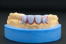 Изготовление полноанатомического мостовидного протеза из литий дисиликата (IPS e.max CAD)