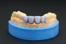 Изготовление полноанатомического мостовидного протеза из литий дисиликата (IPS e.max CAD)