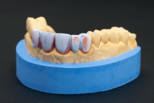Изготовление полноанатомического мостовидного протеза из литий дисиликата (IPS e.max CAD)