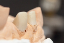 Изготовление культевой вкладки из оксида циркония ZrO2 (IPS e.max ZirCAD)