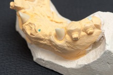 Изготовление культевой вкладки из оксида циркония ZrO2 (IPS e.max ZirCAD)