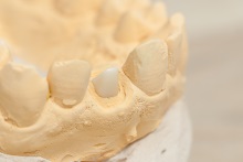 Изготовление культевой вкладки из оксида циркония ZrO2 (IPS e.max ZirCAD)