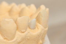 Изготовление культевой вкладки из оксида циркония ZrO2 (IPS e.max ZirCAD)