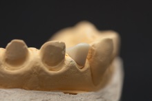 Изготовление культевой вкладки из оксида циркония ZrO2 (IPS e.max ZirCAD)