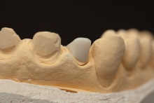 Изготовление культевой вкладки из оксида циркония ZrO2 (IPS e.max ZirCAD)