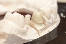 Изготовление каркаса из оксида циркония (IPS e.max ZirCAD)