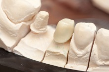 Изготовление каркаса из оксида циркония (IPS e.max ZirCAD)