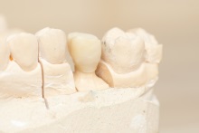 Изготовление каркаса из оксида циркония (IPS e.max ZirCAD)