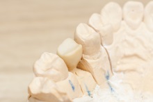 Изготовление каркаса из оксида циркония (IPS e.max ZirCAD)