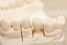 Изготовление каркаса из оксида циркония (IPS e.max ZirCAD)