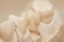 Изготовление каркаса из оксида циркония (IPS e.max ZirCAD)