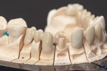 Изготовление каркаса из оксида циркония (IPS e.max ZirCAD)