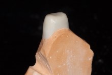 Изготовление каркаса из оксида циркония (IPS e.max ZirCAD)