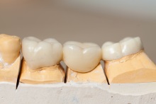 Изготовление каркаса из оксида циркония (IPS e.max ZirCAD)