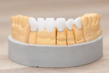 Изготовление каркаса мостовидного протеза из оксида циркония (IPS e.max ZirCAD)