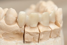 Изготовление каркаса мостовидного протеза из оксида циркония (IPS e.max ZirCAD)