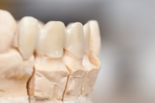 Изготовление каркаса мостовидного протеза из оксида циркония (IPS e.max ZirCAD)