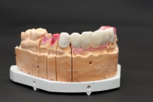 Изготовление каркаса мостовидного протеза из оксида циркония (IPS e.max ZirCAD)
