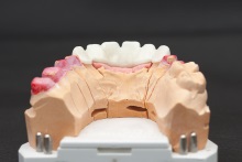 Изготовление каркаса мостовидного протеза из оксида циркония (IPS e.max ZirCAD)