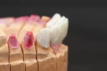 Изготовление каркаса мостовидного протеза из оксида циркония (IPS e.max ZirCAD)