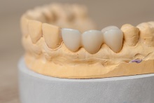 Изготовление коронок, вкладок и виниров из литий дисиликата (IPS e.max CAD)