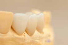 Изготовление коронок, вкладок и виниров из литий дисиликата (IPS e.max CAD)