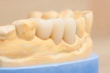 Изготовление коронок, вкладок и виниров из литий дисиликата (IPS e.max CAD)