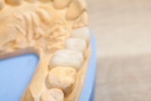 Изготовление коронок, вкладок и виниров из литий дисиликата (IPS e.max CAD)