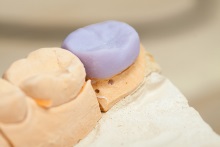 Изготовление коронок, вкладок и виниров из литий дисиликата (IPS e.max CAD)