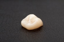 Изготовление коронок, вкладок и виниров из литий дисиликата (IPS e.max CAD)