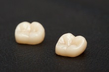 Изготовление коронок, вкладок и виниров из литий дисиликата (IPS e.max CAD)